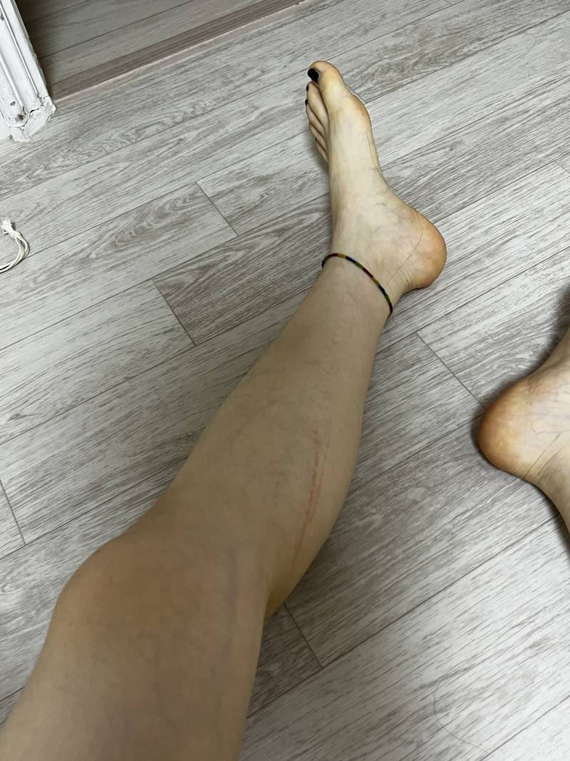 [잡담] 요가링이나 압박 스타킹 신은 다음에 자국 부위 두드러기 나본 사람 있어? (ㅎㅇㅈㅇ) | 인스티즈
