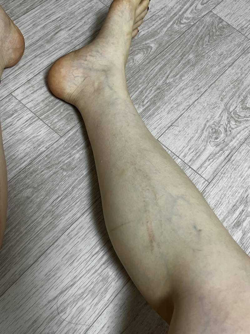 [잡담] 요가링이나 압박 스타킹 신은 다음에 자국 부위 두드러기 나본 사람 있어? (ㅎㅇㅈㅇ) | 인스티즈