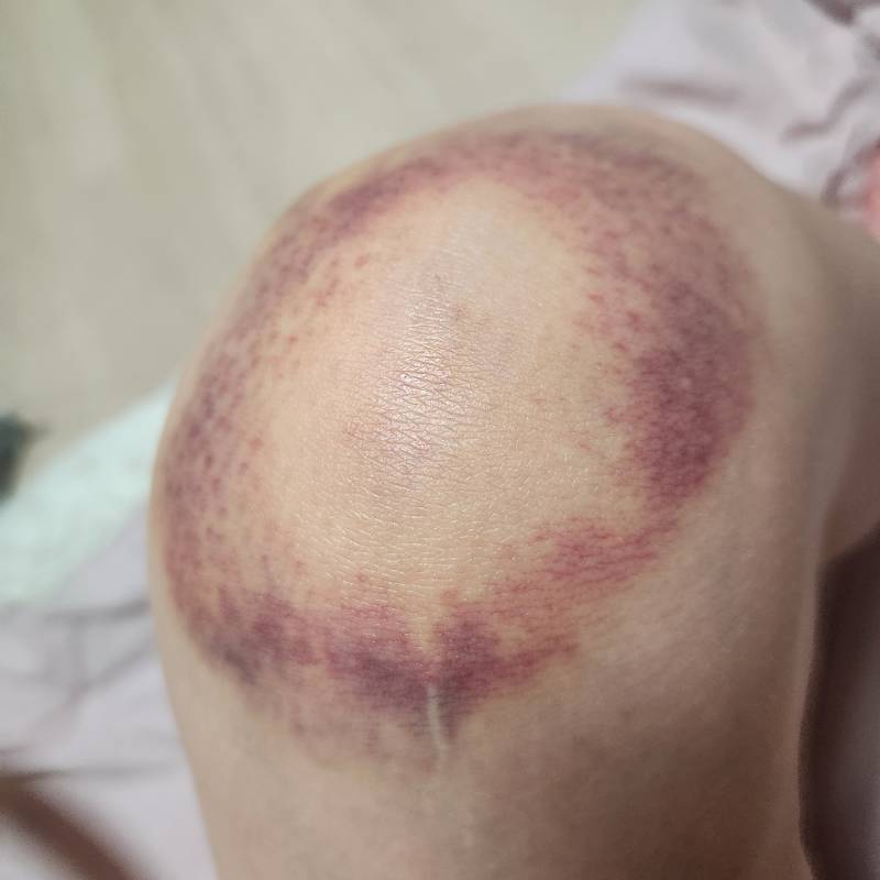 [잡담] 내가 멍든 게 반지 모양이라 친구한테 윌유메리미 함 | 인스티즈