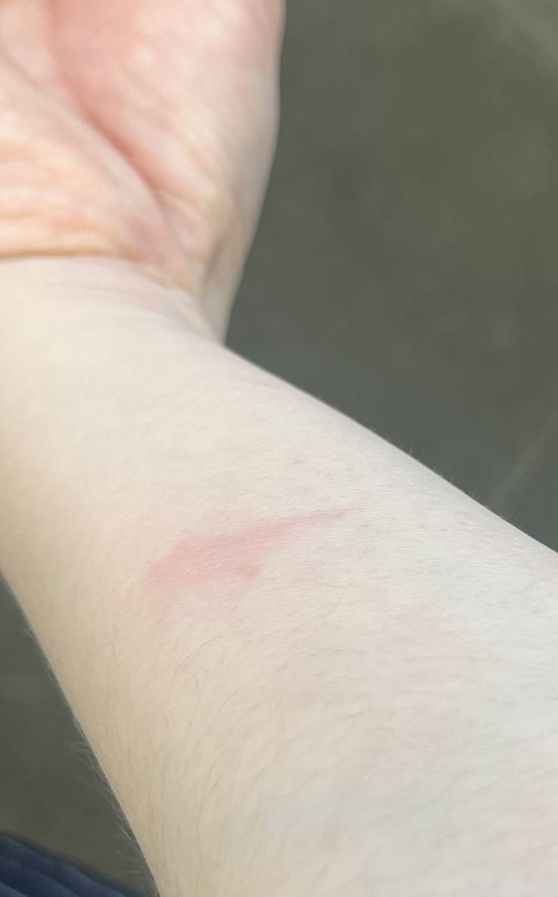 [잡담] 이정도 화상 입었는데 그냥 약만 바를까 메디폼 붙일까 | 인스티즈
