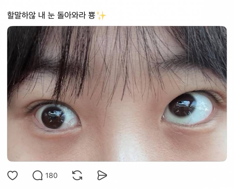 (충격주의) 현재 난리 난 눈밑 지방제거술 부작용 | 인스티즈
