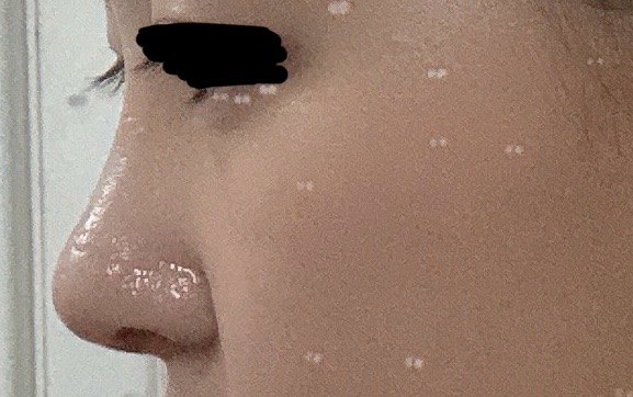 [잡담] 얘들아 이 코 성형코같냐 | 인스티즈