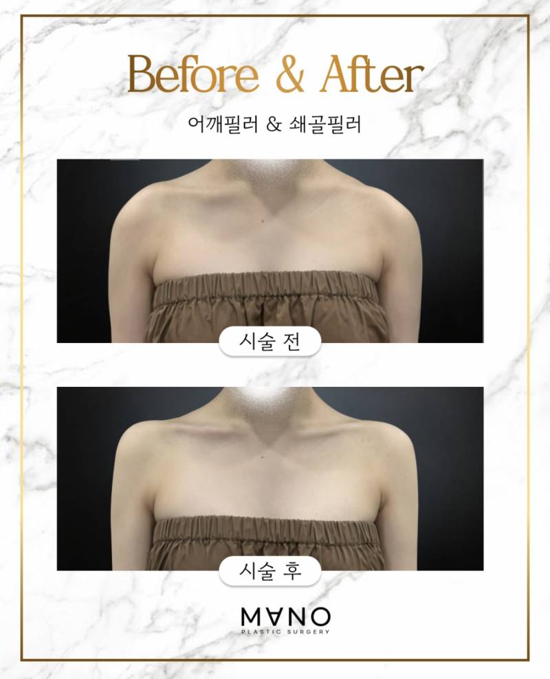 요즘 초인기라는 어깨 필러 전후..JPG | 인스티즈