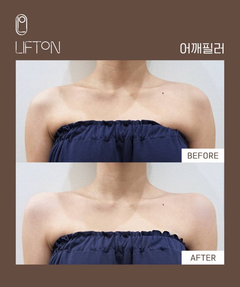 요즘 초인기라는 어깨 필러 전후..JPG | 인스티즈