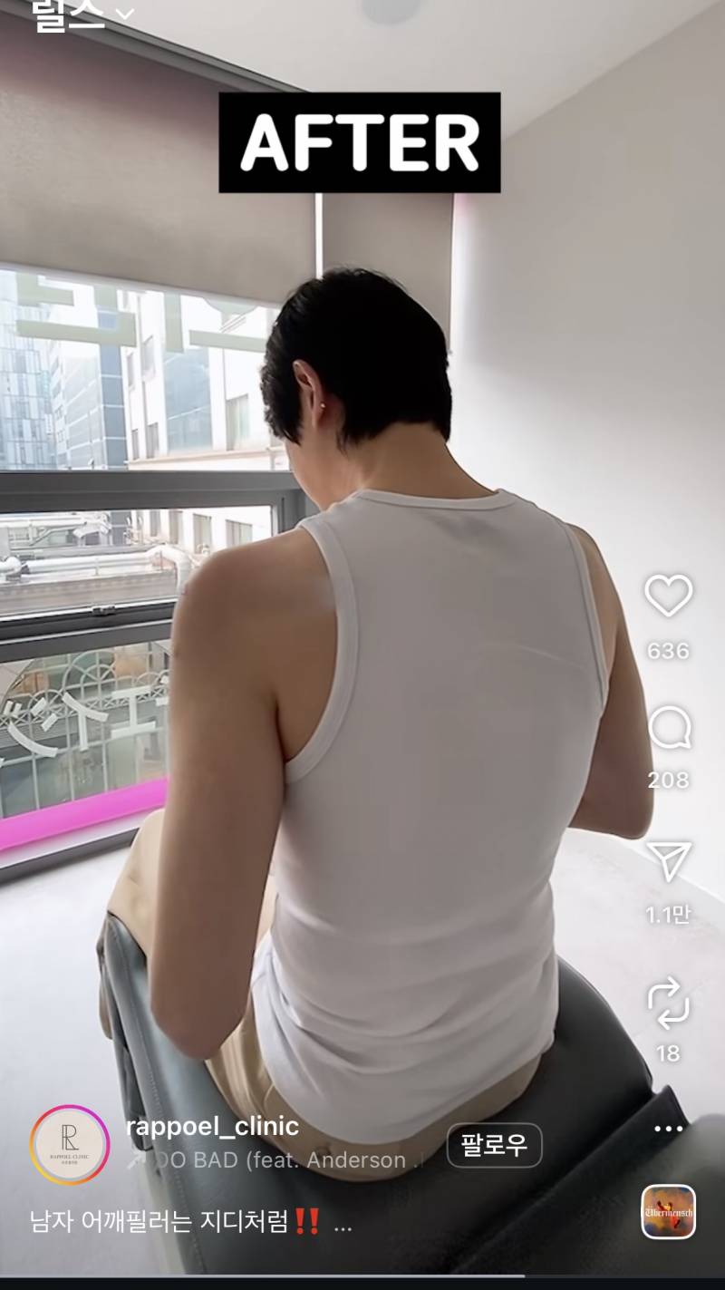 요즘 초인기라는 어깨 필러 전후..JPG | 인스티즈