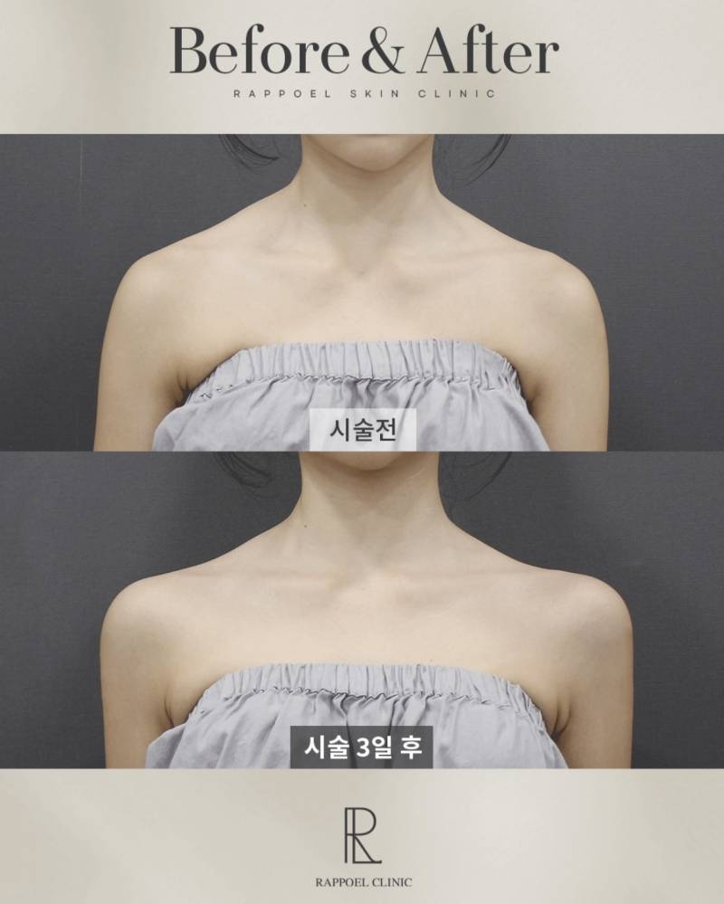 요즘 초인기라는 어깨 필러 전후..JPG | 인스티즈