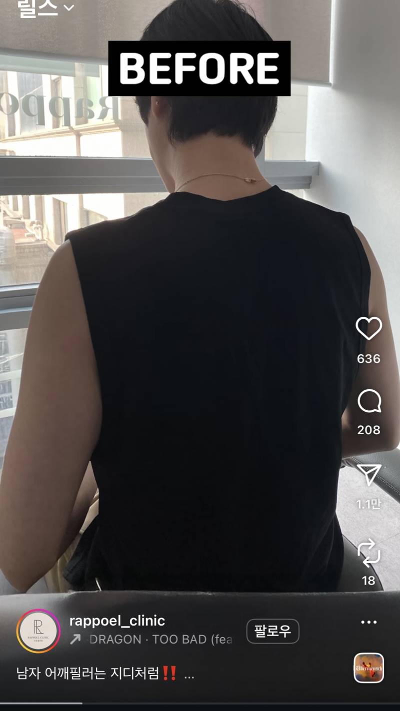 요즘 초인기라는 어깨 필러 전후..JPG | 인스티즈