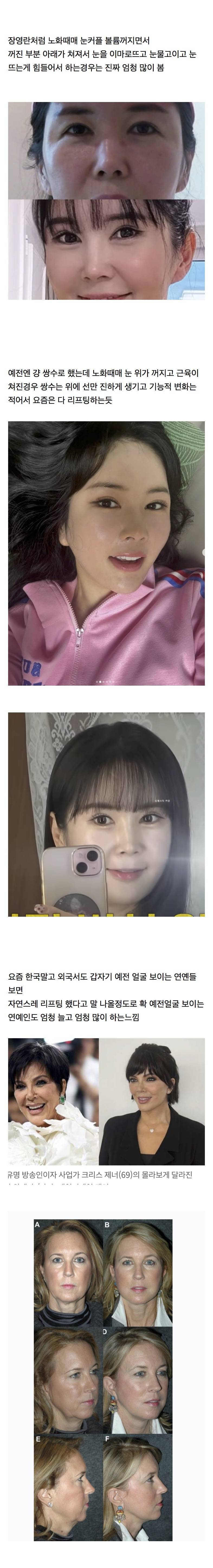 요즘 유행중인거 체감되는 성형.JPG | 인스티즈