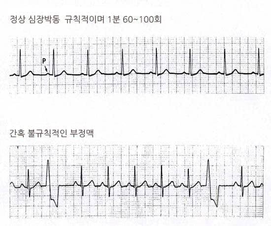 상당히 많은 사람이 가지고 있지만 자각하지 못하는 심장병 | 인스티즈