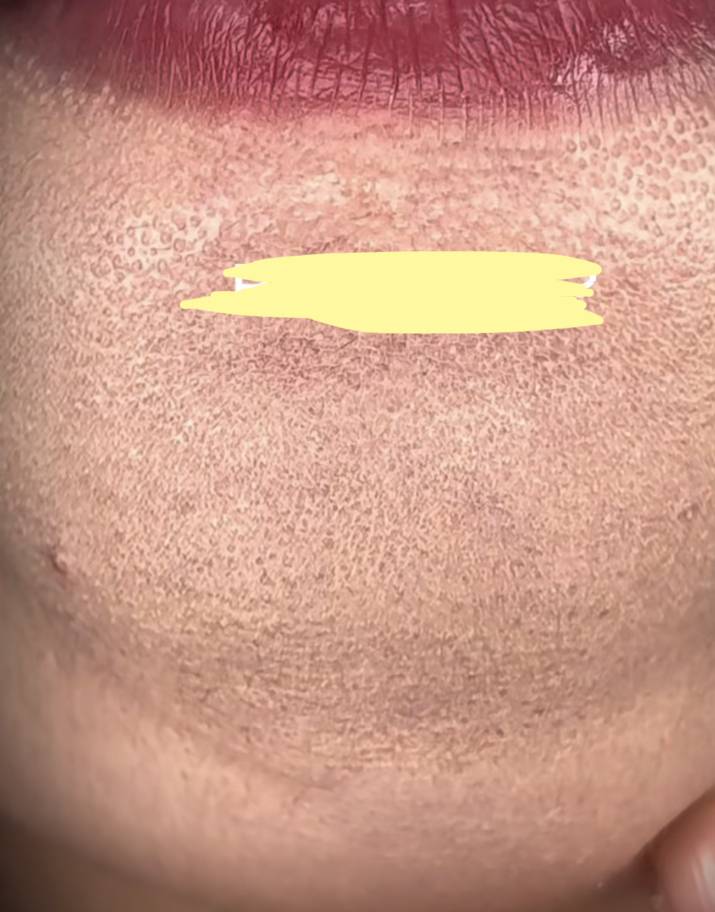 [잡담] 여름에 돌아다니면 피부 이런 사람 많이 봄 | 인스티즈