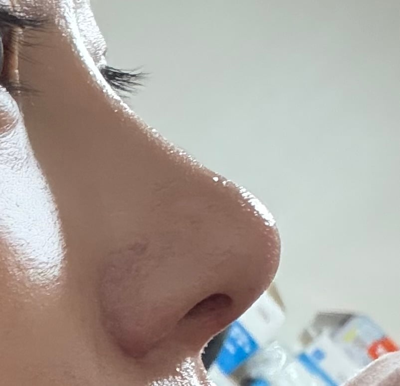 [잡담] 코성형했는데 어떤거같아 | 인스티즈
