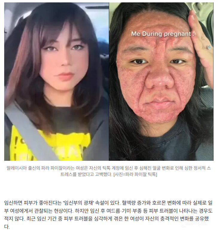 임신하고 돌처럼 변한 피부.jpg | 인스티즈
