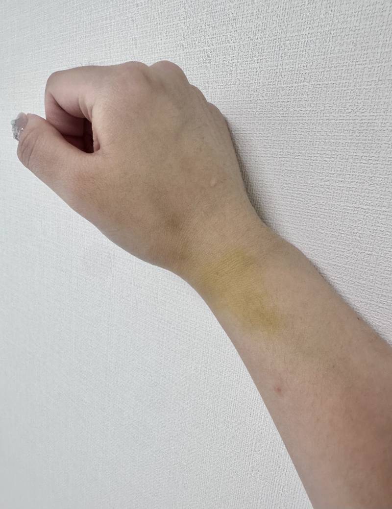 [잡담] 내 손목 이렇게 된건 간호사가 잘못한거지..? ㅜ | 인스티즈