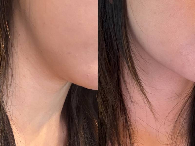 [잡담] 근데 리프팅이나 볼륨 시술은 진짜 원장 디자인이 다인 듯 | 인스티즈