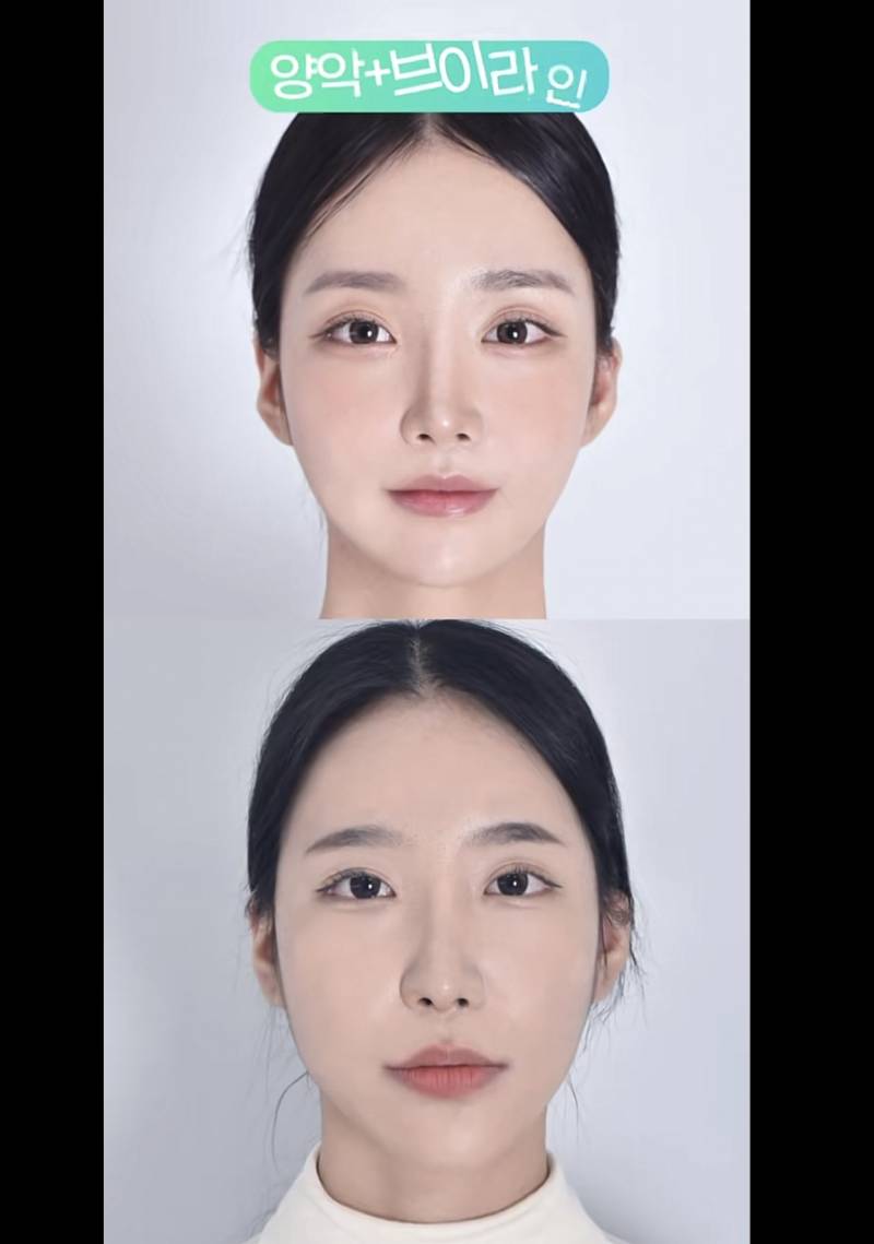 [잡담] 양악 효과가 이정도라고?? 레전드인데? | 인스티즈