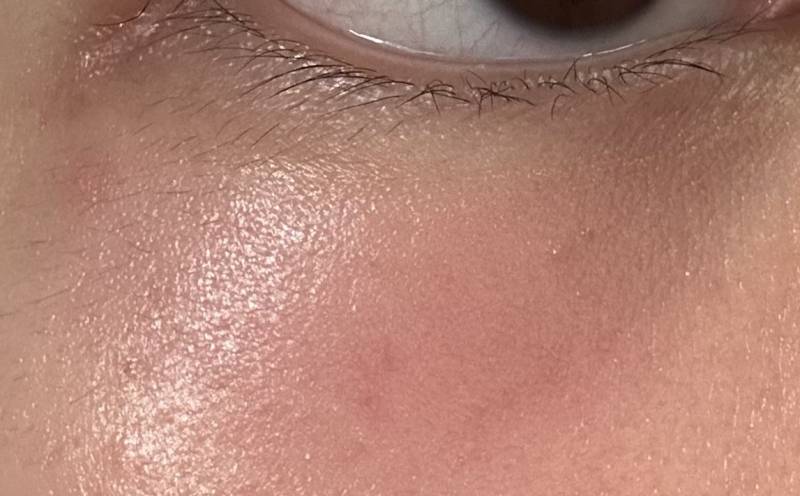 [잡담] 이거 눈다래끼야 여드름이야??? ㅠㅠ | 인스티즈
