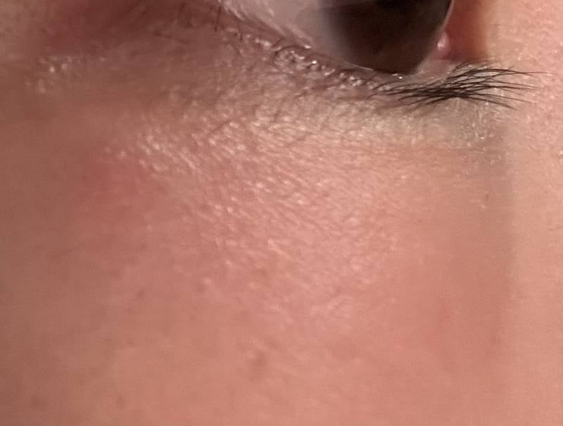[잡담] 이거 눈다래끼야 여드름이야??? ㅠㅠ | 인스티즈
