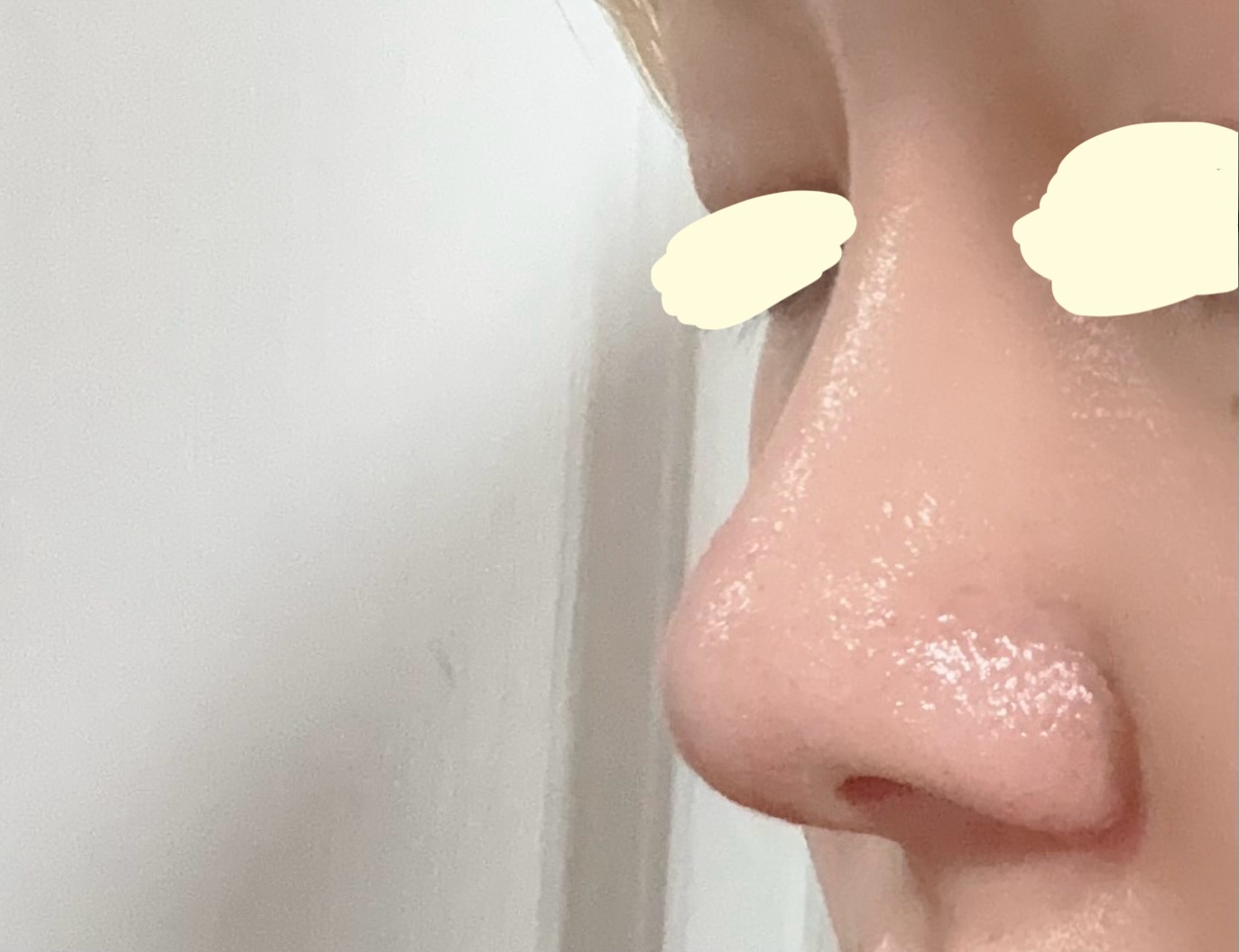 [잡담] 코성형했는데 높이 낮나? | 인스티즈