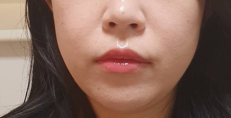 [잡담] 하 팔자주름 어떻게 없애 | 인스티즈