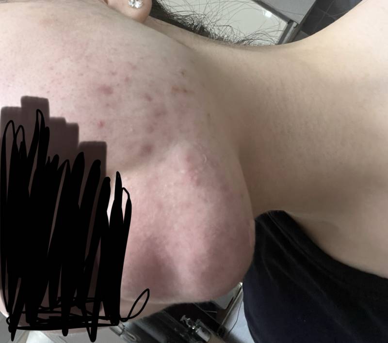 [잡담] 여드름 조언좀 해줄 사람...? 이거 피부장벽 무너진거야?😭 사진ㅇ | 인스티즈