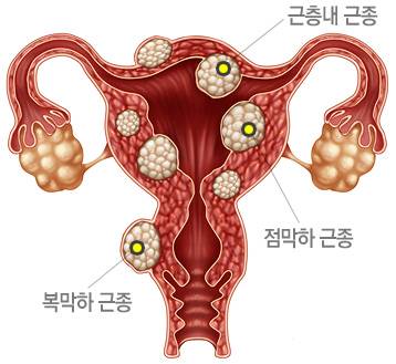 [잡담] 생리통 심한 애들 초음파 꼭 찍어보셈 | 인스티즈