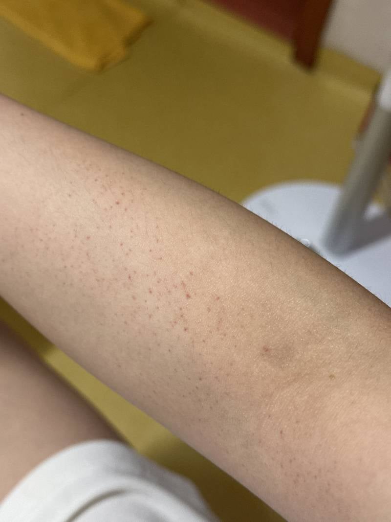 [잡담] 턱보톡스랑 윤곽주사 부작용(?) 피부과 잘알들 ㅈㅂ ㅠ | 인스티즈