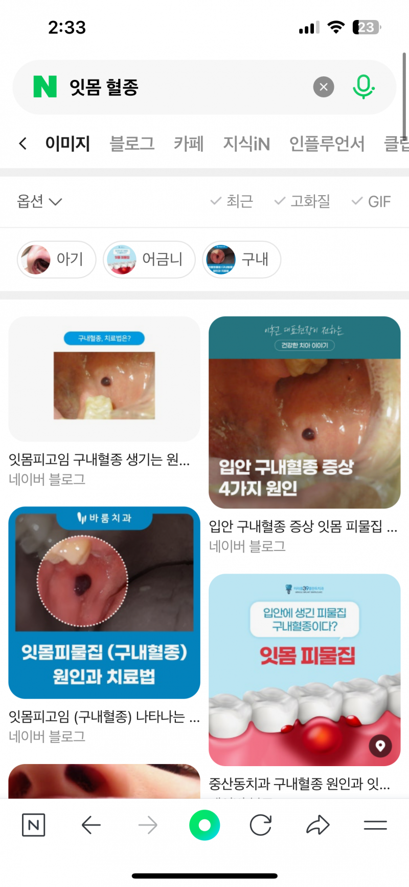 [잡담] 익들아 이거 치과가서 터쳐달라하면 해주나 | 인스티즈