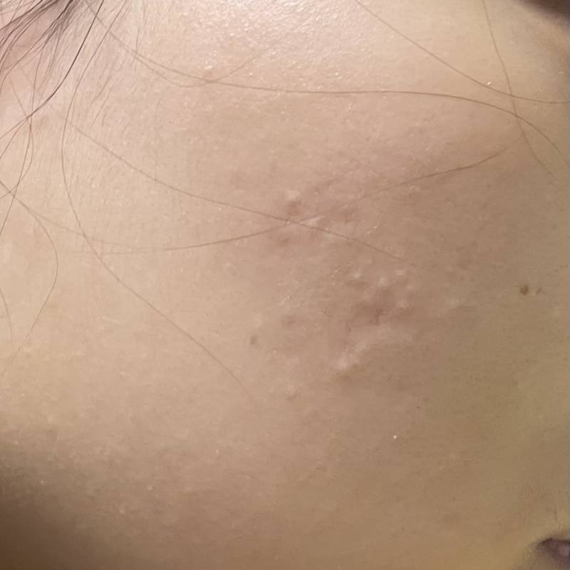 [잡담] 내 피부 한번만 봐줘..뭘 해야 없어질까 이런 여드름은..ㅠ 사진O | 인스티즈