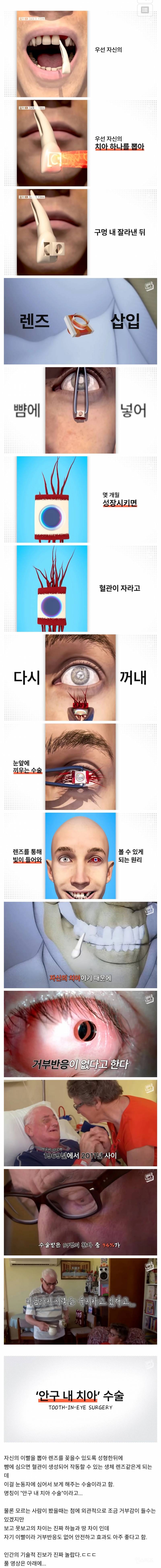 치아를 눈에 넣어 실명을 치료하는 안구 내 치아 수술 | 인스티즈