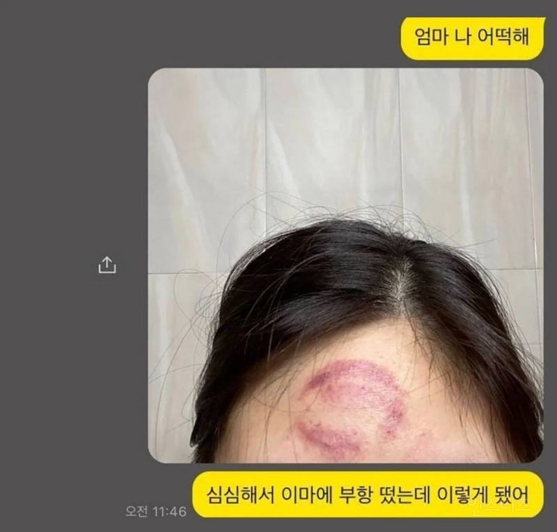 머리에 부황 뜬 딸이 한심했던 어머니.jpg | 인스티즈