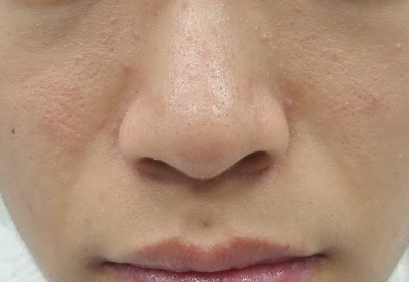 [잡담] 피부 많이 심한거야? | 인스티즈