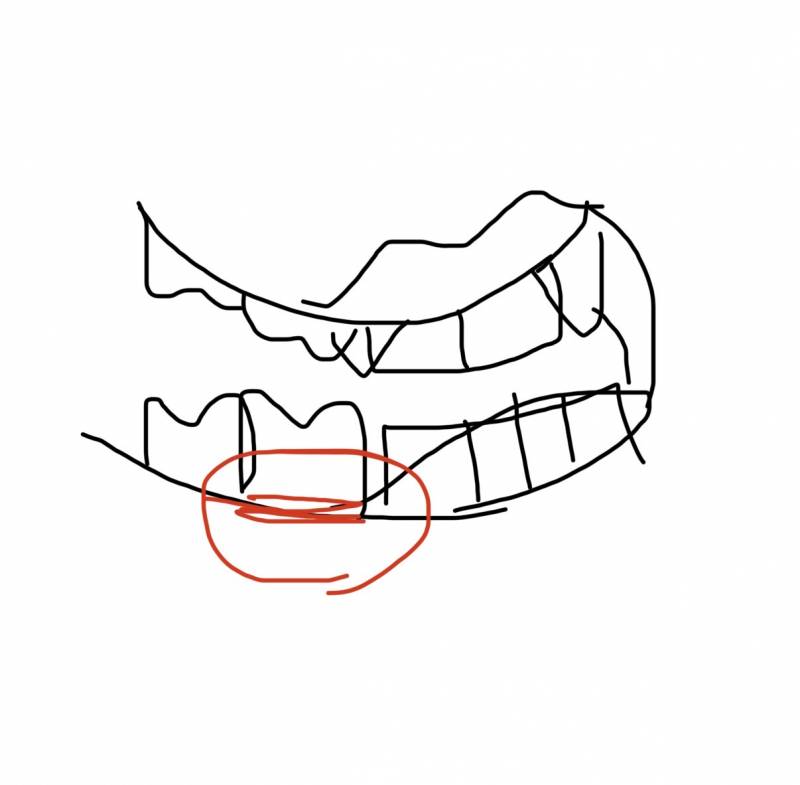 [잡담] 혹시 치과에서 근무하시는 분ㅠㅠㅠ어금니랑 잇몸 사이에 검은 줄이 있는데 뭘까 | 인스티즈