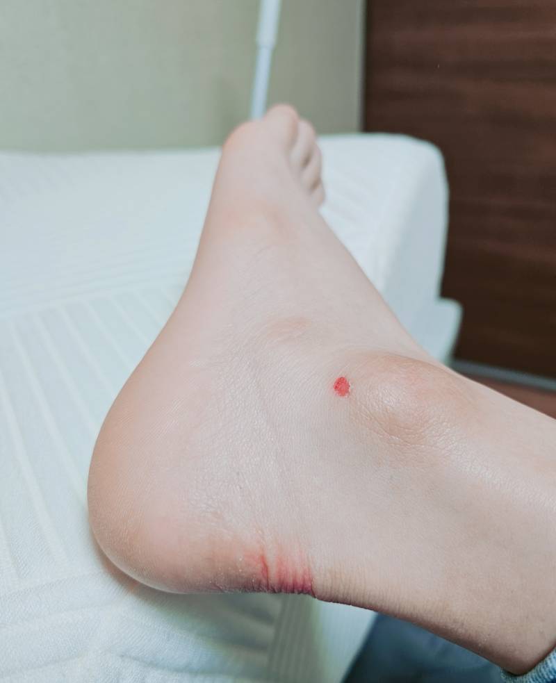 [잡담] 사진주의)복숭아뼈 까짐.. | 인스티즈