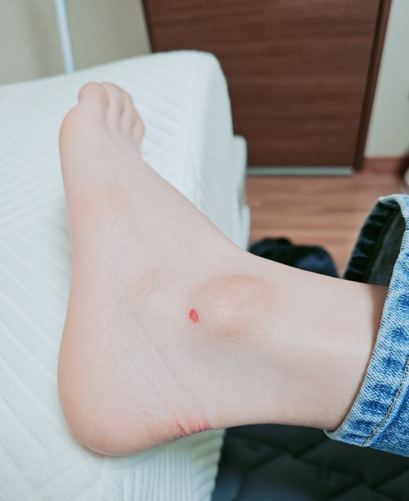 [잡담] 사진주의)복숭아뼈 까짐.. | 인스티즈