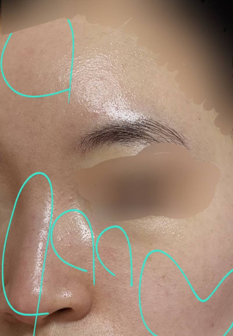 [잡담] 피부 잘알 있어? (피부사진 있음 | 인스티즈
