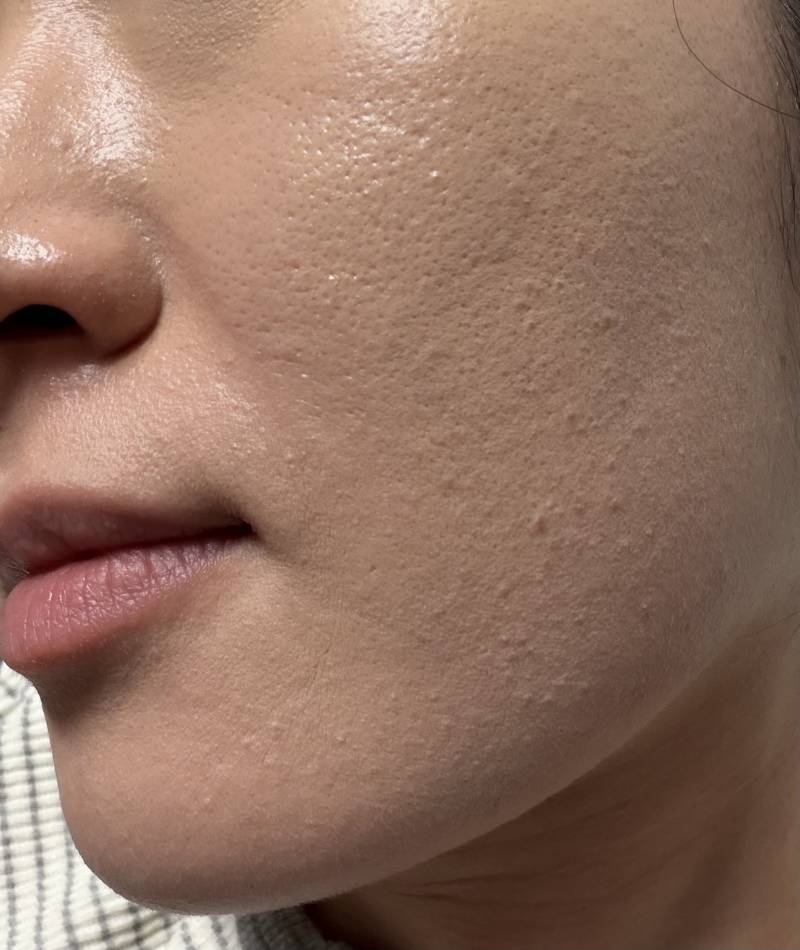 [잡담] 나 이거 얼굴에 난거 이름이 뭘까..?ㅠㅜㅠ 바글거려서 너무 징그러워 | 인스티즈