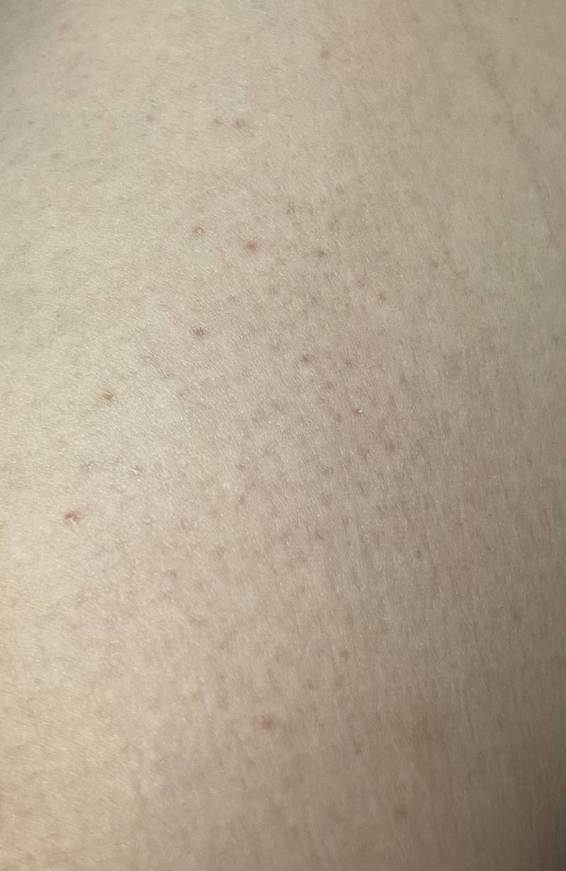 [잡담] 종아리에 이런거는 | 인스티즈