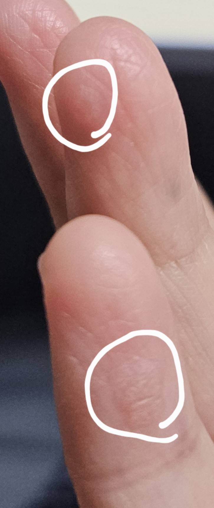 [잡담] 손가락에 사마귀 번진 거 같은데 병원 가야하나ㅠㅠㅠ | 인스티즈