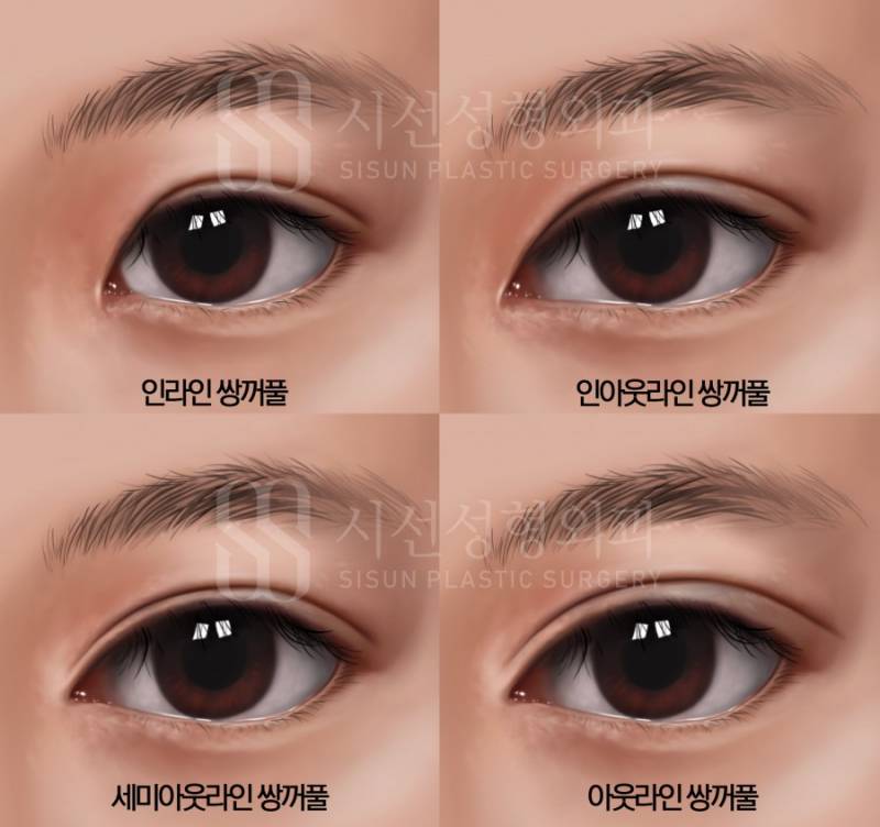 [잡담] 진짜 성형도 유행타는거보면 어릴때하는게 능사가 아닌듯 | 인스티즈