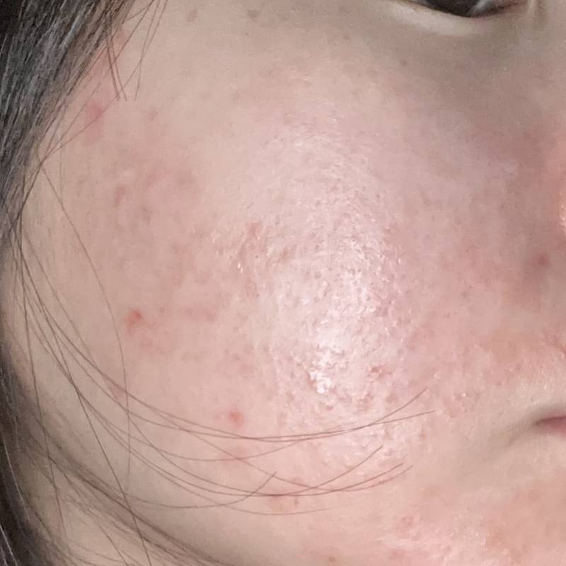 [잡담] 아 피부 너무 스트레스야ㅠㅠ | 인스티즈