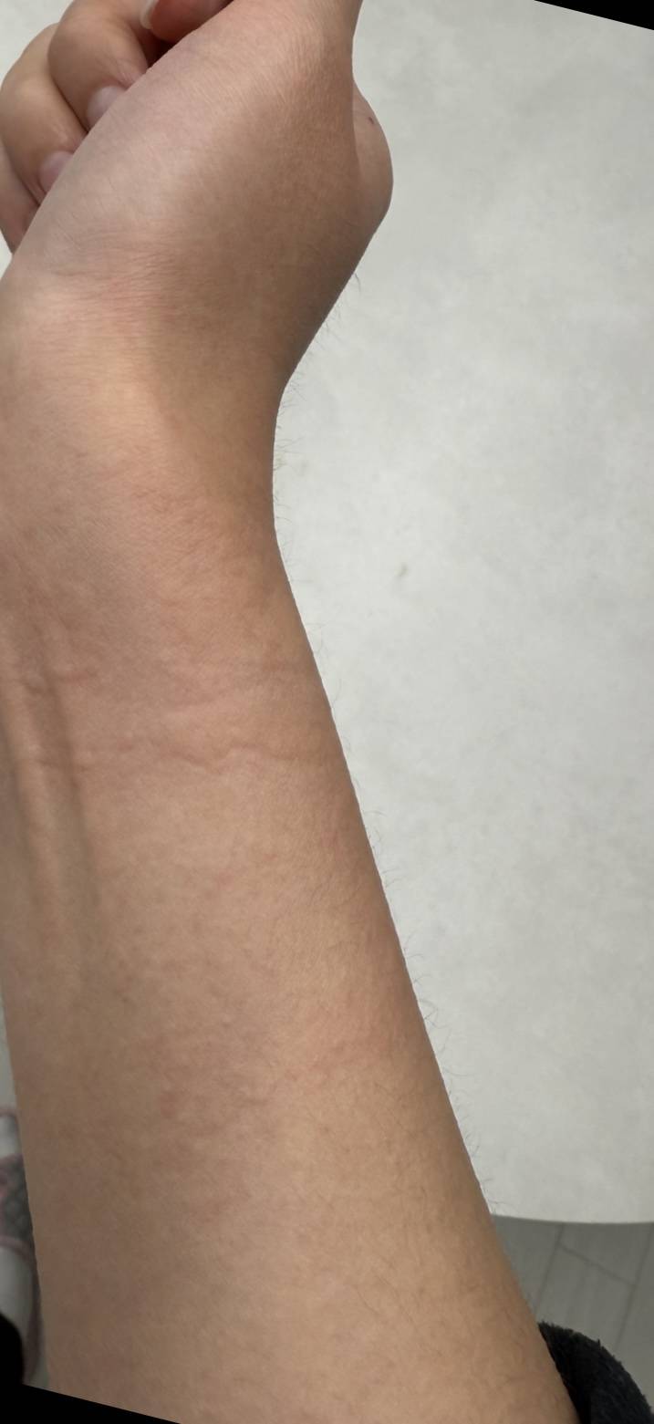 [잡담] 한랭두드러기 진짜진짜 너무싫다..... | 인스티즈
