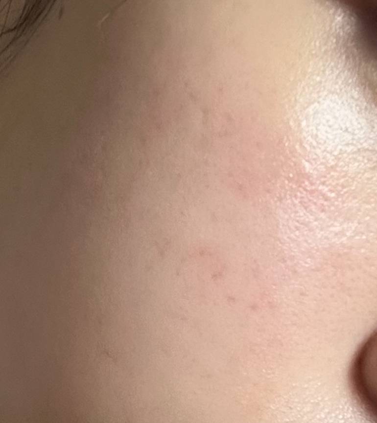 [잡담] 왼쪽 볼만 이렇게 울긋불긋한데 원인이 뭘까 | 인스티즈