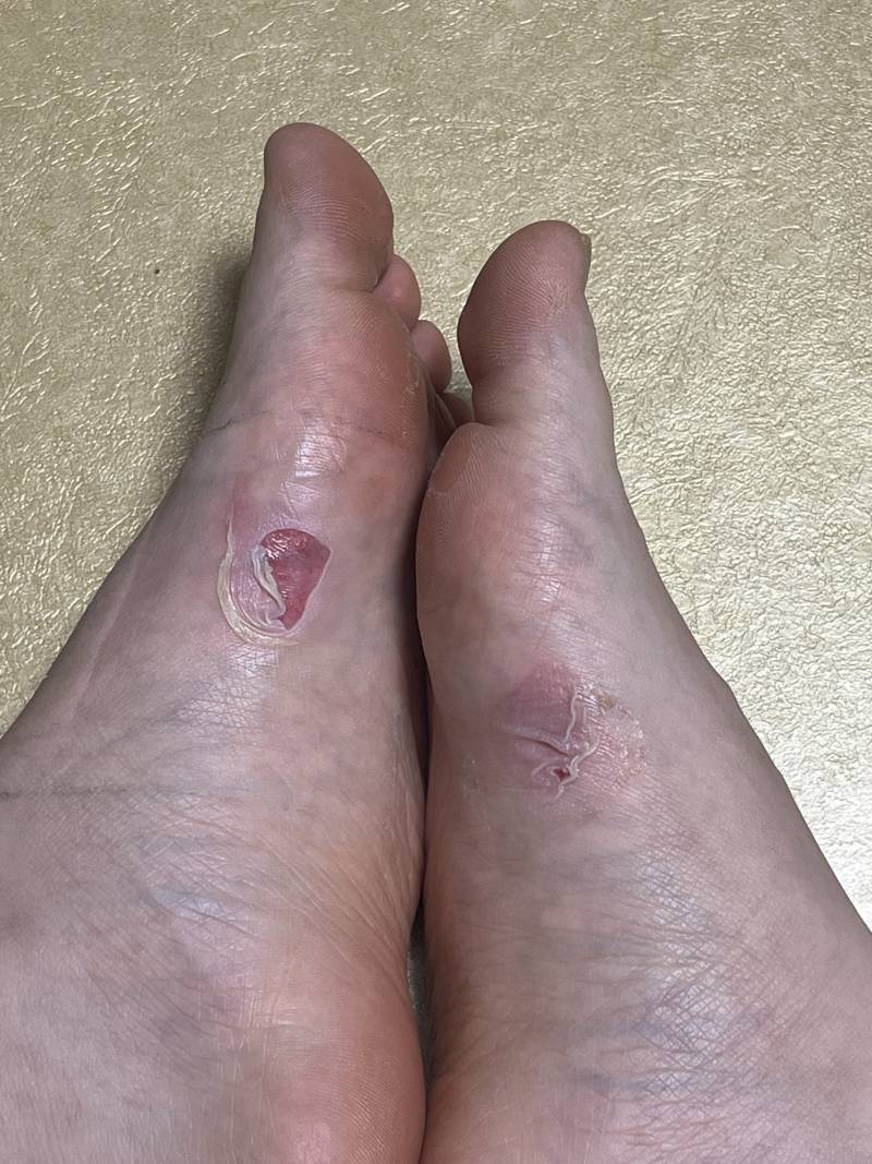 [잡담] (혐주) 발바닥 까진거 너무 아파 ㅠ̑̈ㅠ̑̈ | 인스티즈