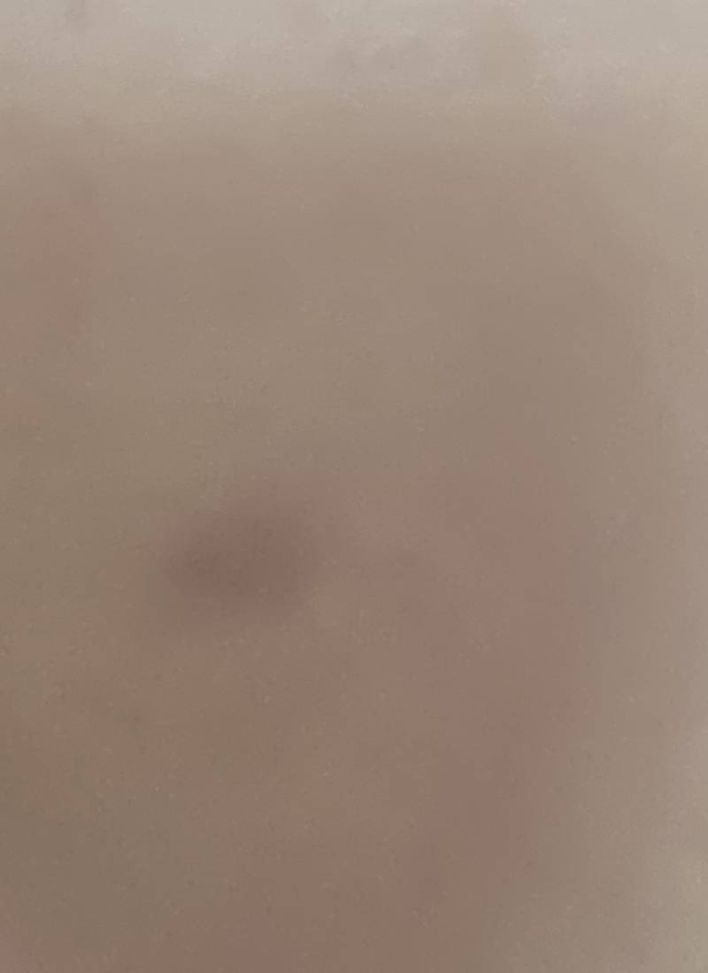 [잡담] 얼굴 염증 피가 뭉쳤는데.... | 인스티즈