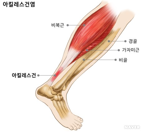 [잡담] 족저근막염, 아킬레스 건염 완치 후기(병원X) | 인스티즈