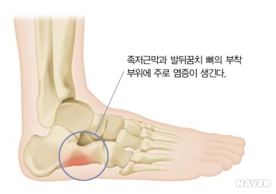 [잡담] 족저근막염, 아킬레스 건염 완치 후기(병원X) | 인스티즈