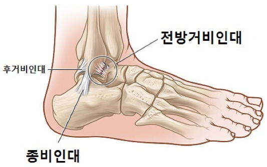 [잡담] 족저근막염, 아킬레스 건염 완치 후기(병원X) | 인스티즈