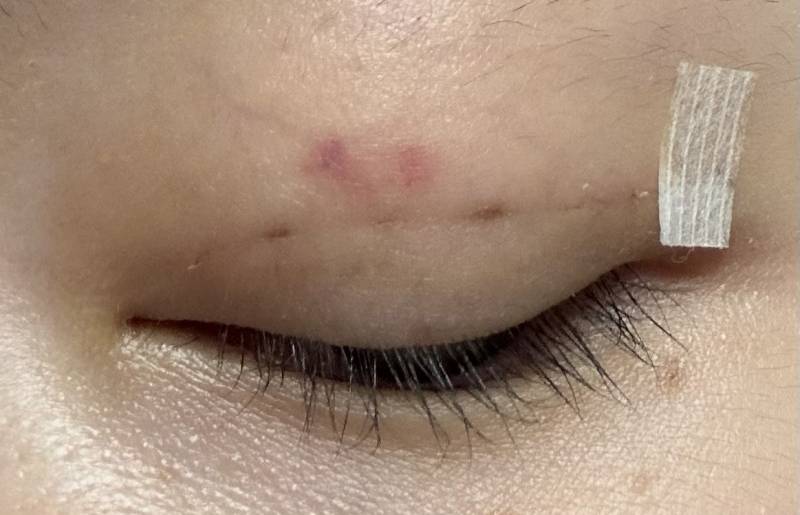 [잡담] 지난 주 월요일에 비절개 눈교 했는데 멍 좀 봐줘 ㅠㅠㅠ | 인스티즈