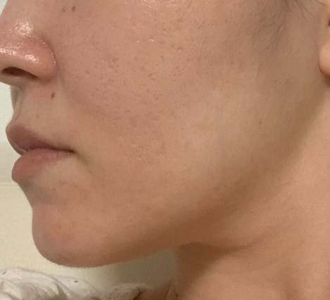 [잡담] 성인여드름으로 피부과 300만원 이상 써본사람?? | 인스티즈