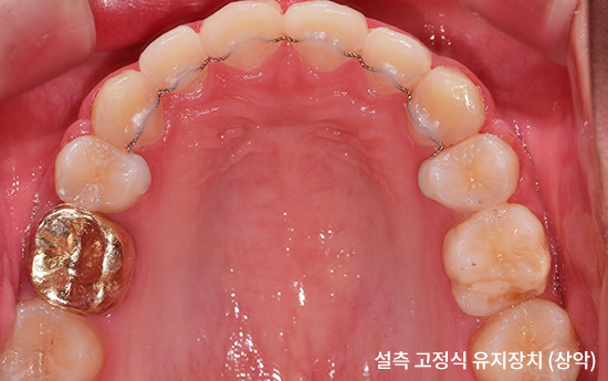 [잡담] 교정한 익들 유지장치 평생 해야하는거 알고 교정했어? | 인스티즈